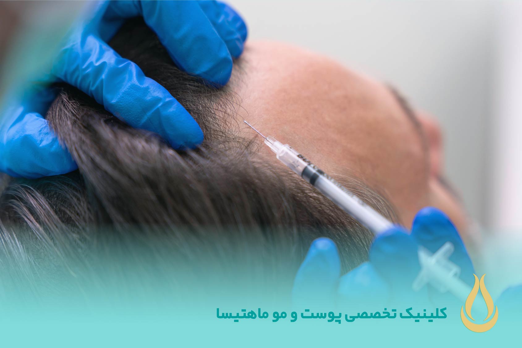 مزوتراپی